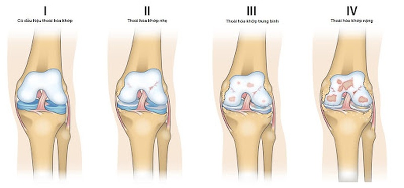 Đau khớp vai và cách điều trị như thế nào cho hiệu quả