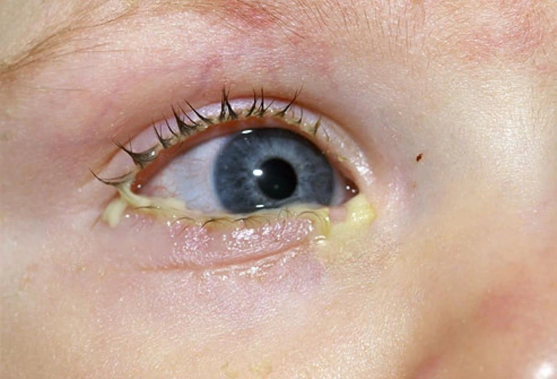 Đau mắt đỏ chảy dịch vàng hoặc xanh là  do đâu 1