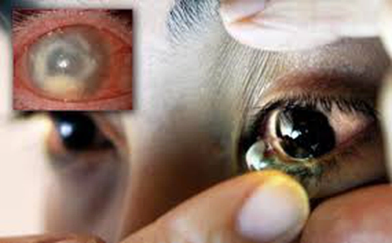 đau mắt đỏ có nên đeo lens