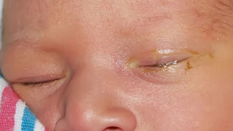 Đau mắt hột ở trẻ em: Nguyên nhân, triệu chứng và cách phòng tránh 3