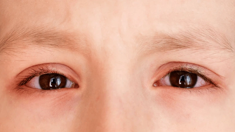 Đau mắt hột ở trẻ em: Nguyên nhân, triệu chứng và cách phòng tránh 1