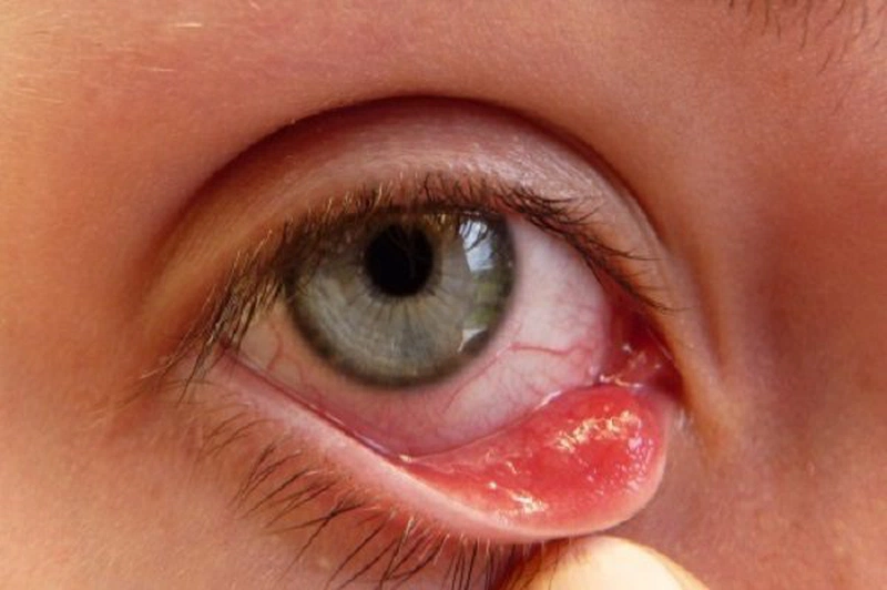 Bệnh đau mắt hột và cách điều trị hiệu quả nhất 2