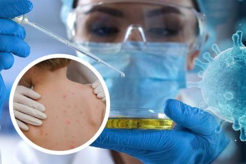 Đậu mùa khỉ: Vaccine đậu mùa khỉ3