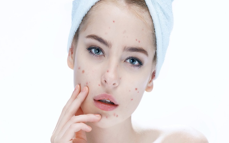 Đầu nhiều gàu, tóc rụng có nguy hiểm không