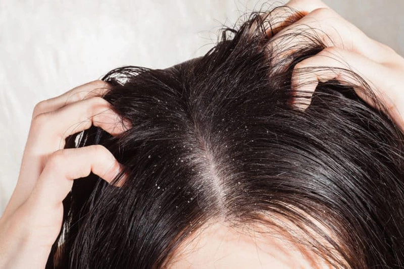 Đầu nhiều gàu, tóc rụng có nguy hiểm không