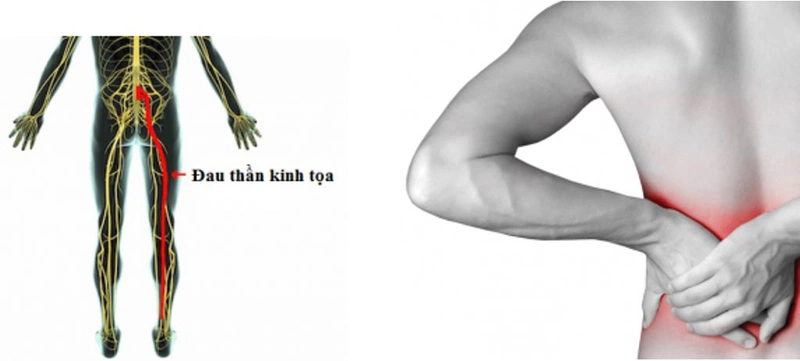 Đau thần kinh tọa có nên tập thể dục không? Các bài tập phù hợp với người đau thần kinh tọa 1