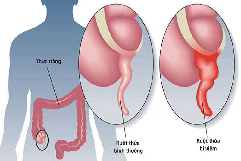 Đau thượng vị buồn nôn báo hiệu điều gì? 2