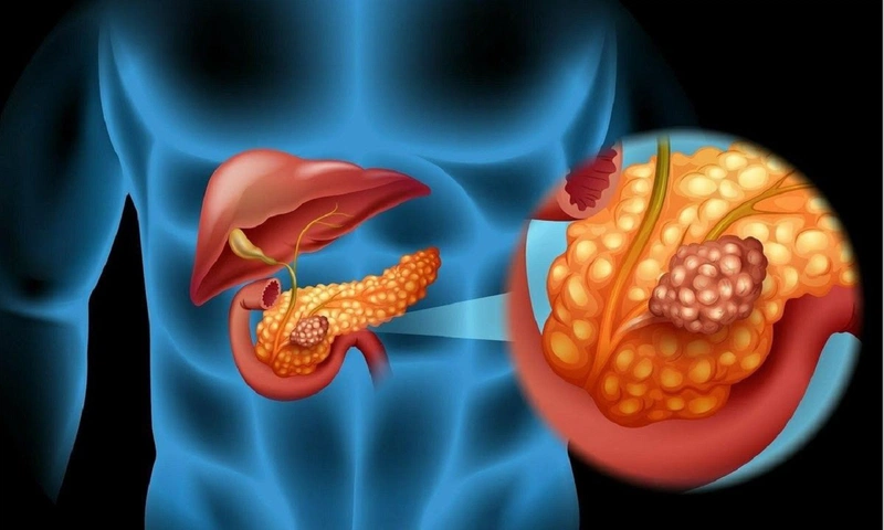 Cách chữa trị đau thượng vị lan ra sau lưng 1