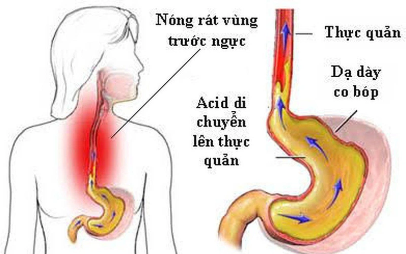 Đau thượng vị về đêm- lời cảnh báo nguy hiểm 2