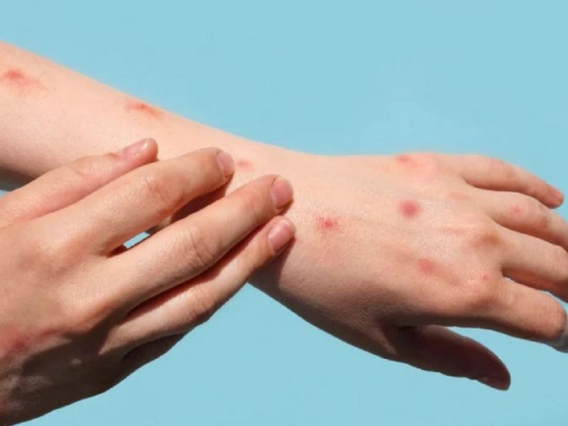 Bệnh đậu mùa khỉ có nguy hiểm không? Triệu chứng và biến chứng bệnh đậu mùa khỉ 2
