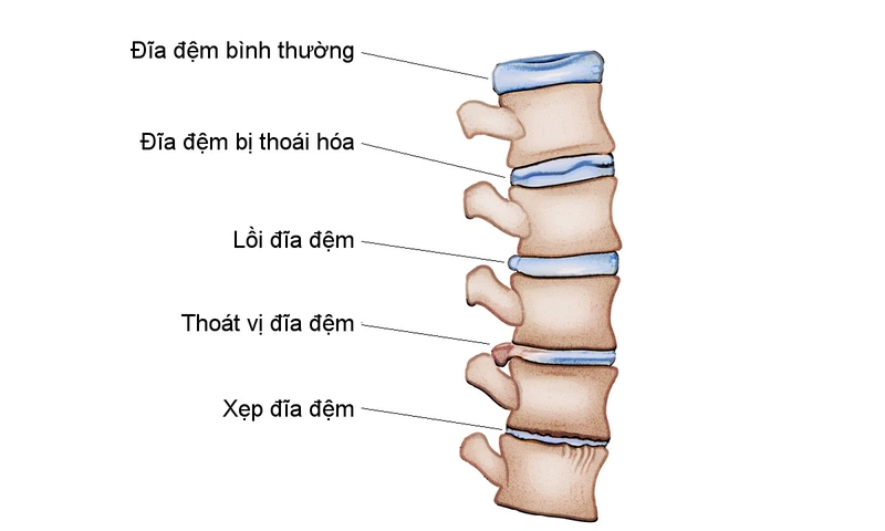 Để chống cong vẹo cột sống cần phải làm gì? Và cách nhận biết? 1