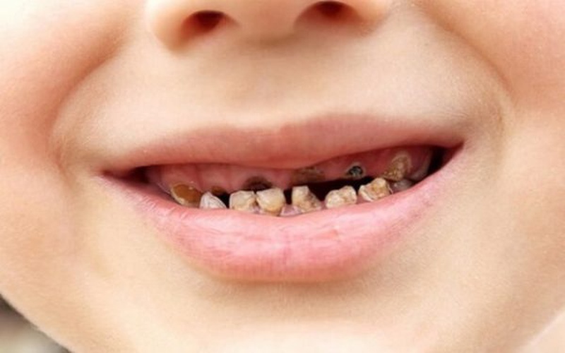 Tác dụng phụ của việc sử dụng kháng sinh không hợp lý đối với răng của trẻ em?
