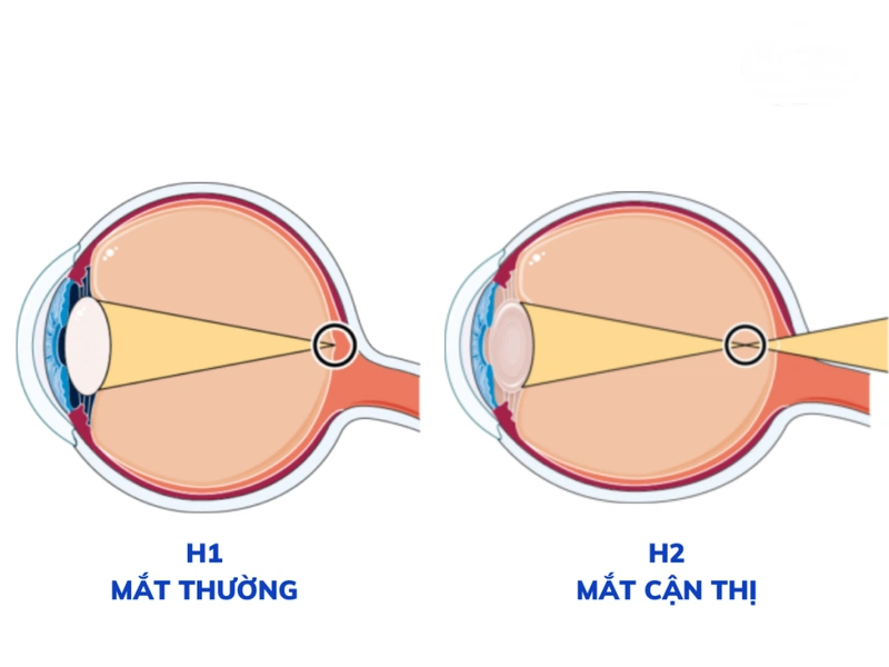 Đeo Kính Cận Bị Đau Đầu: Nguyên Nhân và Giải Pháp Hiệu Quả