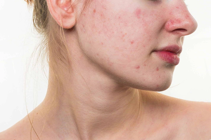 Sự thật về việc dị ứng da mặt có nên rửa nước muối 1