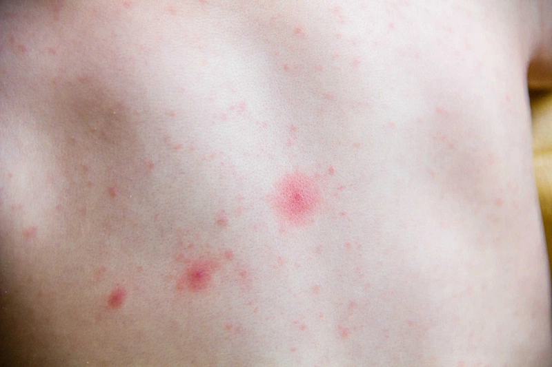 Dị ứng Augmentin có nguy hiểm không? 3