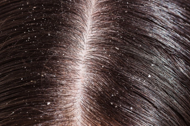 Dị ứng da đầu lâu ngày có thể dẫn đến bệnh lý vảy nến da đầu