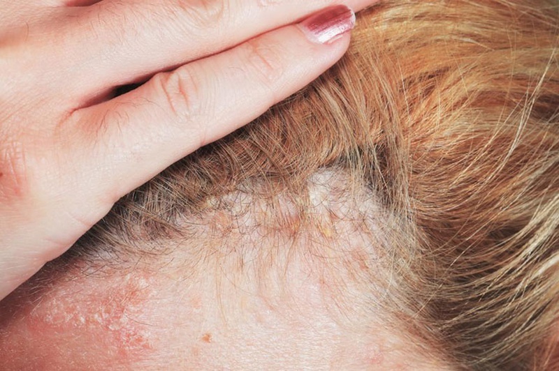 Nên tìm hiểu nguyên nhân dị ứng da đầu trước khi tiến hành điều trị