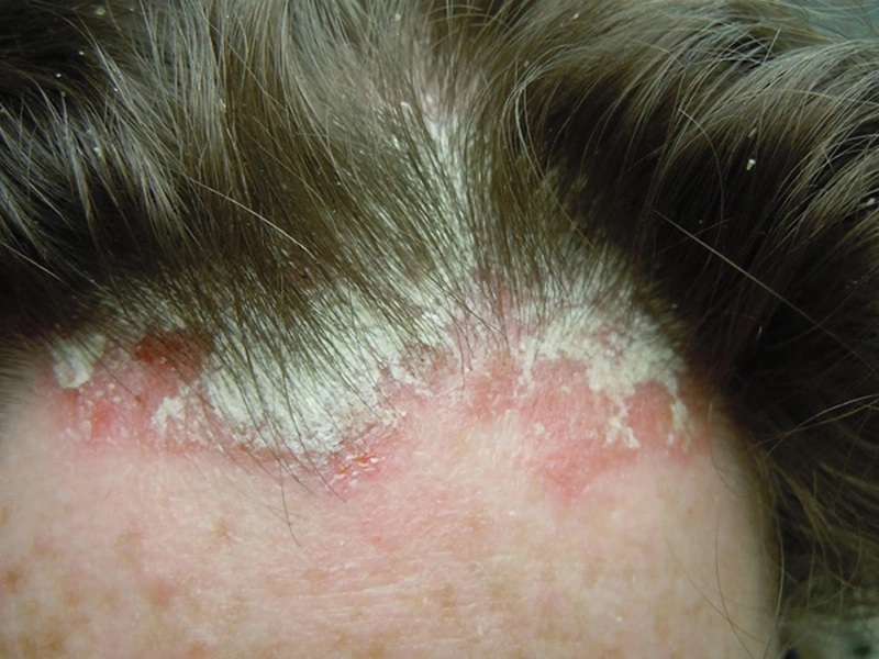 Khuyến khích mỗi bệnh nhân nên sử dụng loại dầu gội lành tính nhất để hạn chế dị ứng da đầu