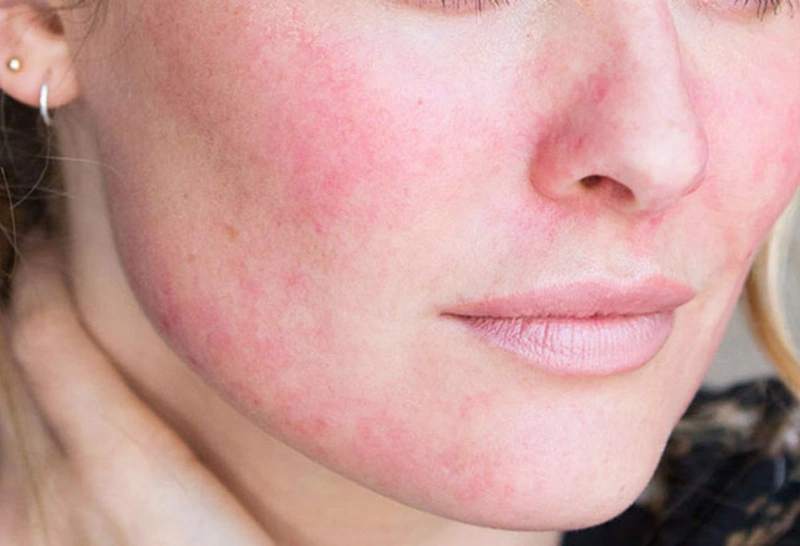 Giải đáp thắc mắc: Thuốc bôi dị ứng trên da mặt Histamin 1