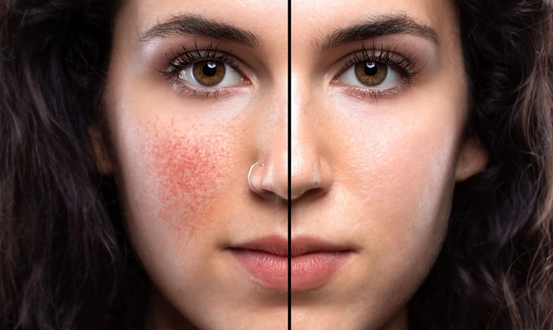 Dị ứng da sau khi xăm là gì? Nguy hiểm ra sao? 1