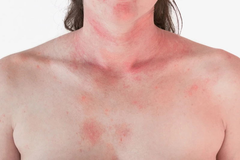 Giải đáp thắc mắc: Dị ứng uống nước dừa có tốt hay không? 1