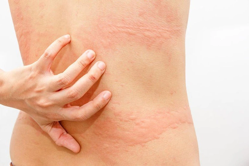 Dị ứng da lưng: nguyên nhân và phương pháp điều trị hiệu quả? 1
