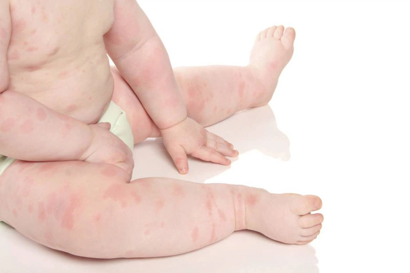 Dị ứng thời tiết ở trẻ em: Nguyên nhân, triệu chứng và cách điều trị hiệu quả 1