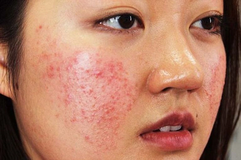 Dị ứng thuốc ở mặt sẽ như thế nào1