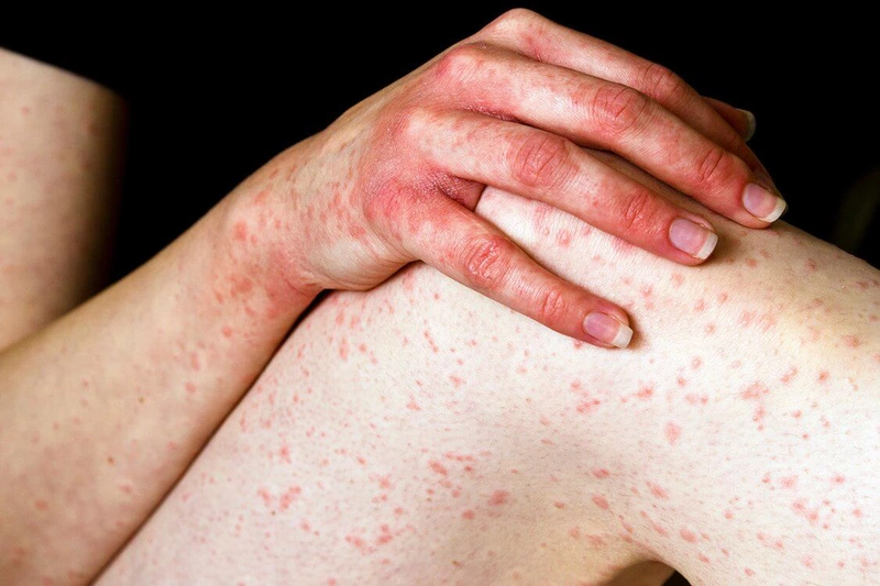 Dị ứng uống nước chanh: Triệu chứng, nguyên nhân và cách khắc phục1