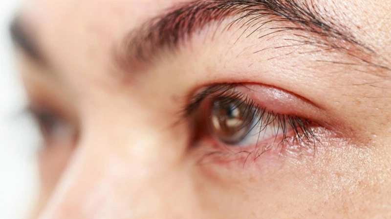 Dị ứng vùng da quanh mắt có nguy hiểm không? 1
