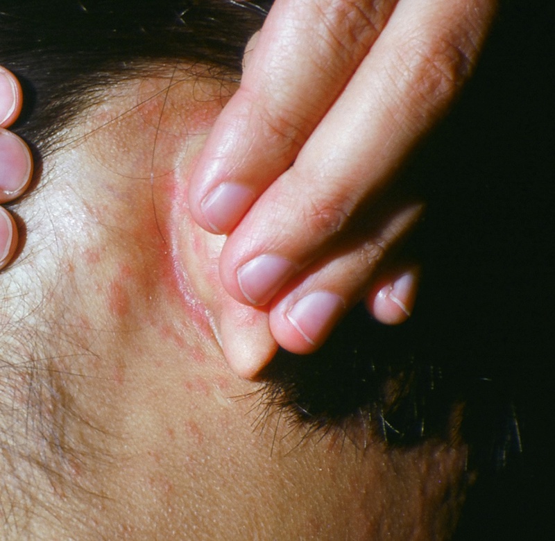 Cách phòng tránh dịch sởi rubella trước khi vào mùa cao điểm 1