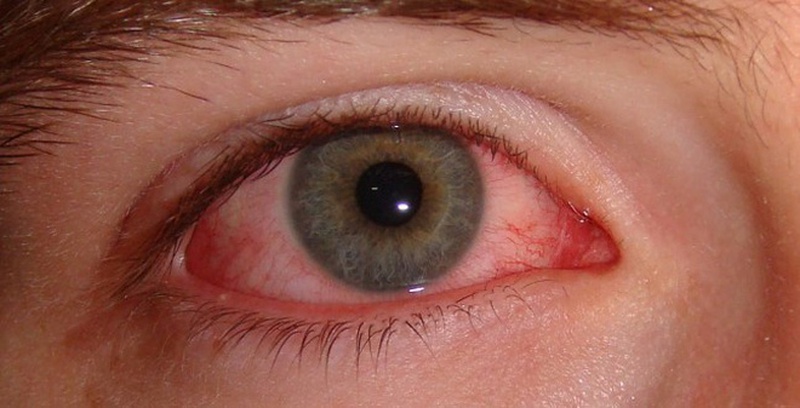 Điểm mặt 6 dấu hiệu nhận biết bệnh khô mắt thường gặp2
