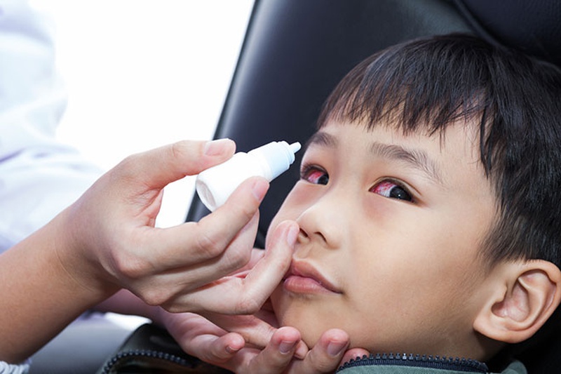 Diễn biến bệnh đau mắt đỏ và cách chăm sóc hiệu quả cho bé