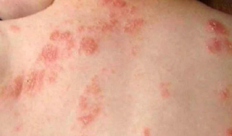 Bệnh chốc lở là bệnh gì?