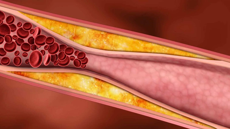 Rối loạn lipid máu là tình trạng tăng nồng độ cholesterol hoặc triglycerid