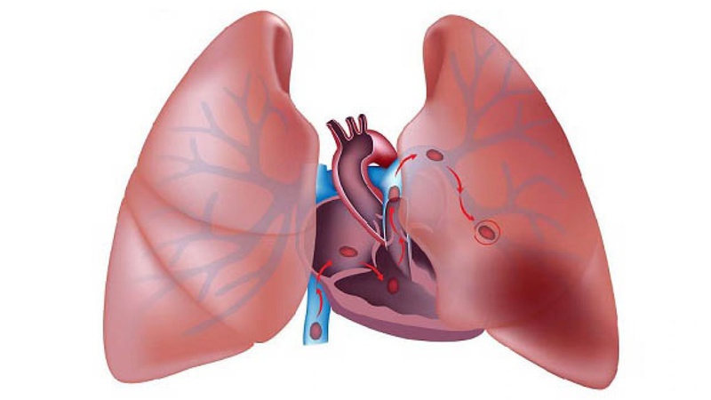 Thuyên tắc phổi là tình trạng động mạch phổi bị tắc nghẽn, thường là do huyết khối tĩnh mạch sâu chi dưới
