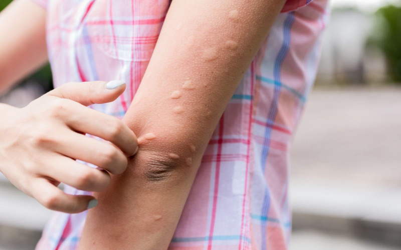 Mề đay lâu năm hay còn gọi là mề đay mãn tính là bệnh mề đay kéo dài trên 6 tuần
