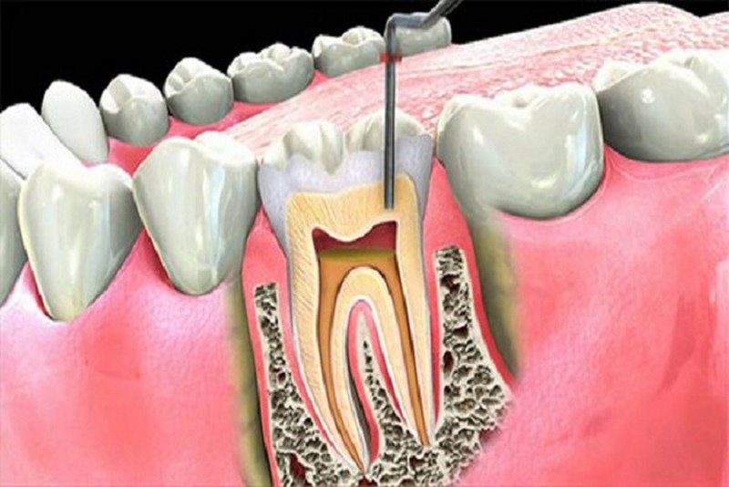 Điều trị tủy răng có đau không