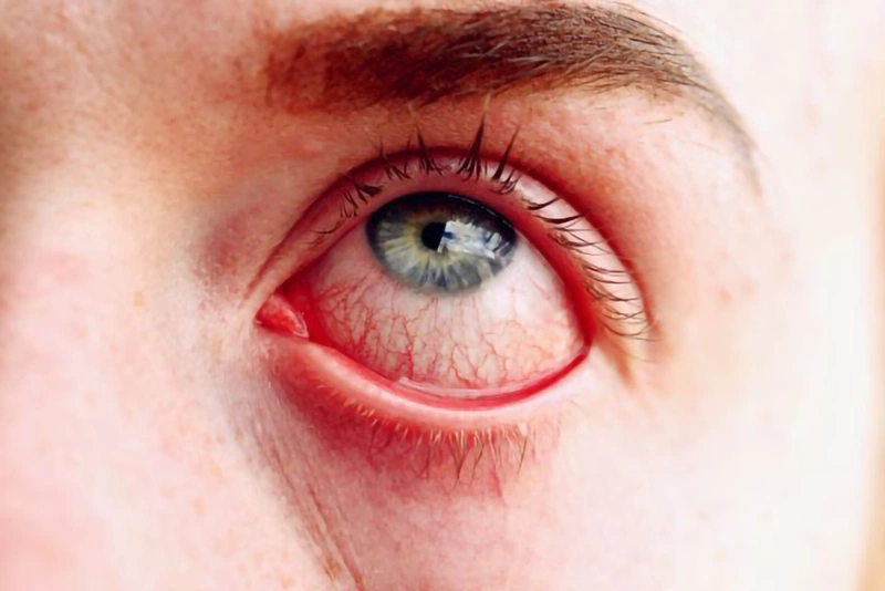 Viêm kết mạc giả mạc thường gặp nhất là viêm giác mạc do virus hoặc nhiễm trùng mắt do lậu cầu