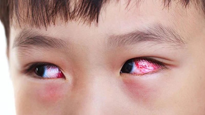 Viêm kết mạc hay bệnh đau mắt đỏ là tình trạng nhiễm trùng niêm mạc của mắt