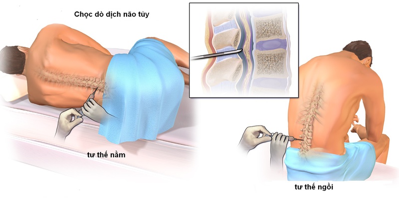 điều trị viêm màng não virus 2