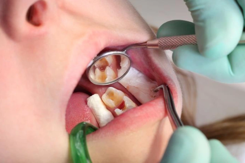 Điều trị viêm tủy răng ở trẻ em có nên hay không?  2