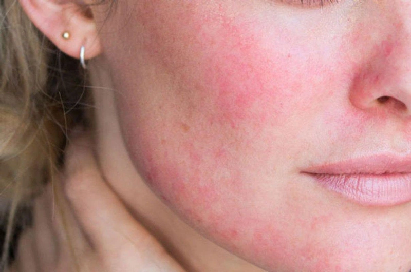 Bạn không nên sử dụng niacinamide kết hợp với Differin ở giai đoạn đầu vì có thể gây kích ứng da sớm
