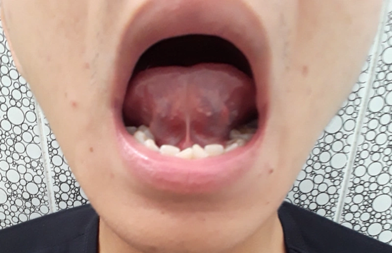 Trẻ bị dính thắng lưỡi chậm nói và những điều cần lưu ý.