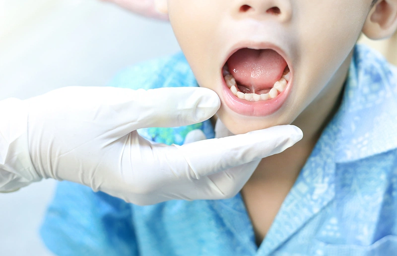 Dính thắng lưỡi ở trẻ 3 tuổi - Xử lý như thế nào? 2