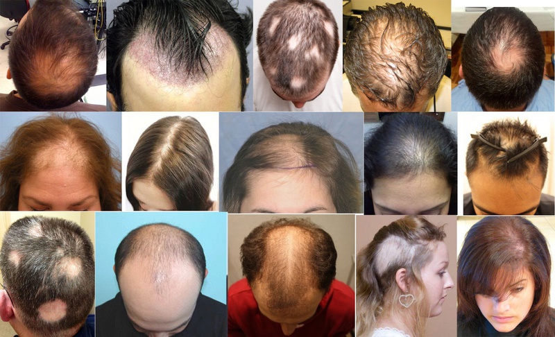 Có nhiều người bị rụng tóc từng mảng