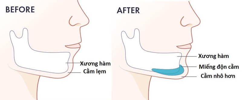 Độn cằm an toàn không? Những ưu và nhược điểm của phương pháp độn cằm 2