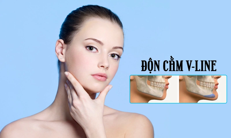 Độn cằm an toàn không? Những ưu và nhược điểm của phương pháp độn cằm 1