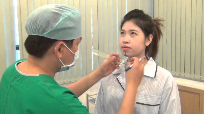 Độn cằm an toàn không? Những ưu và nhược điểm của phương pháp độn cằm 4