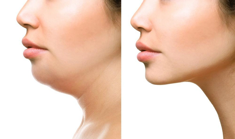 Độn cằm lẹm - cách khắc phục chiếc cằm bị lẹm hiệu quả1